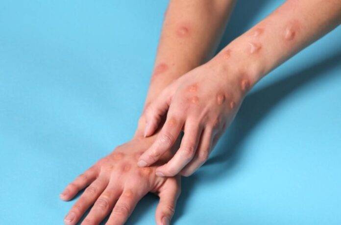 Tailandia confirma primer caso de nueva variante de mpox en Asia