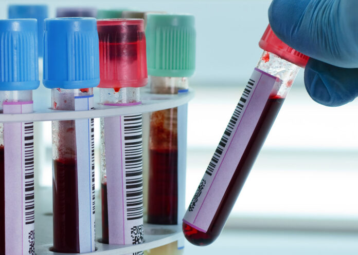 Nuevo análisis de sangre podría sustituir biopsias de médula ósea en la detección temprana de leucemia.